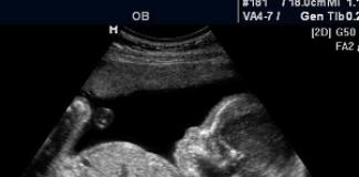 Geplante Ultraschalluntersuchungen während der Schwangerschaft. Ultraschalluntersuchungen während der Schwangerschaft