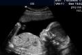 Scheduled ultrasounds during pregnancy Ultrasounds during pregnancy timing