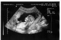 Warum wird in der siebten bis neunten Schwangerschaftswoche ein Ultraschall durchgeführt?