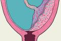 چگونه خونریزی واژن را در دوران بارداری متوقف کنیم؟